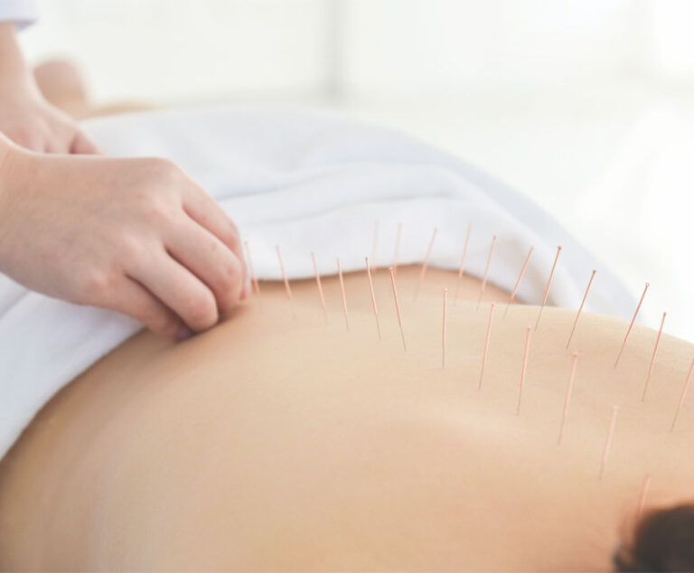 Photo of patient receiving acupuncture