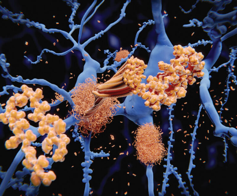 Alzheimer's disease amyloid plaques