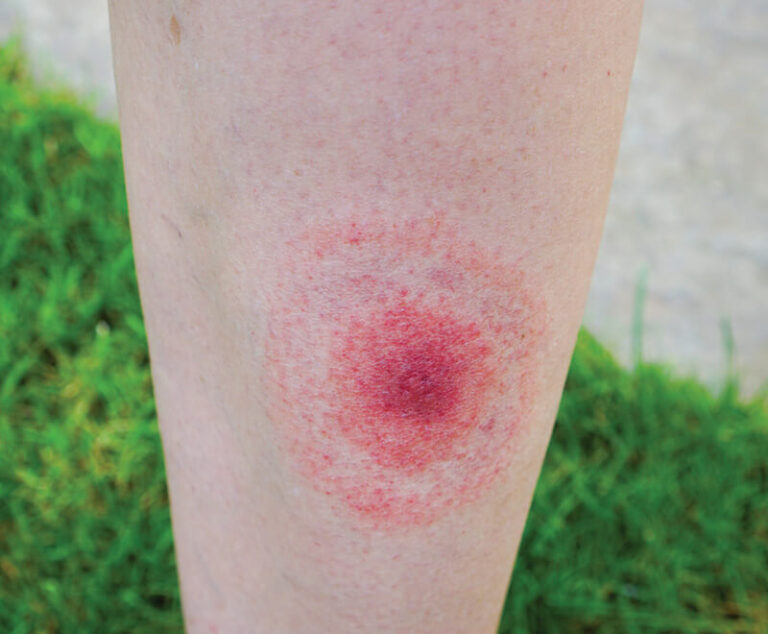 Lyme disease