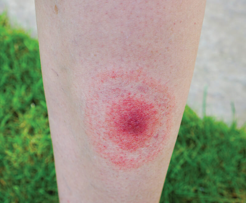 Lyme disease