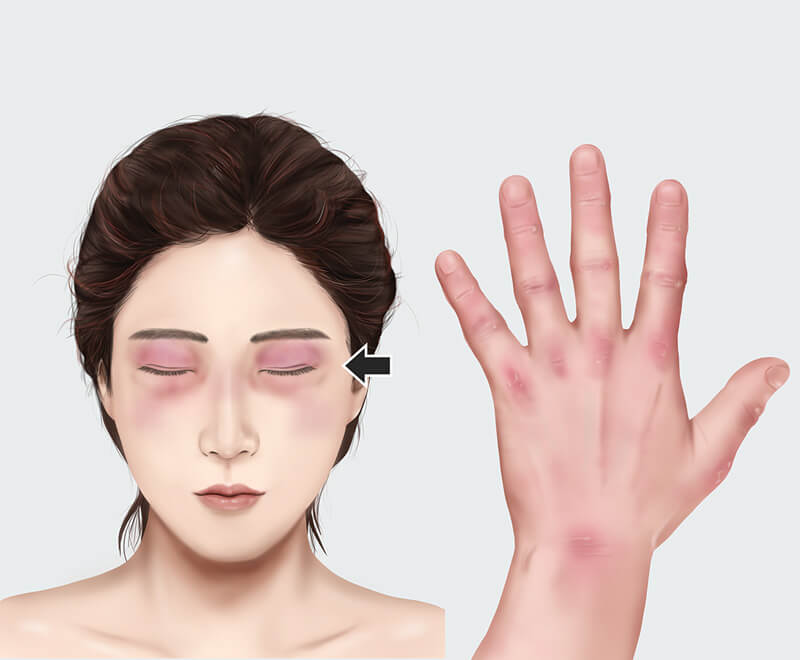 Dermatomyositis illustration