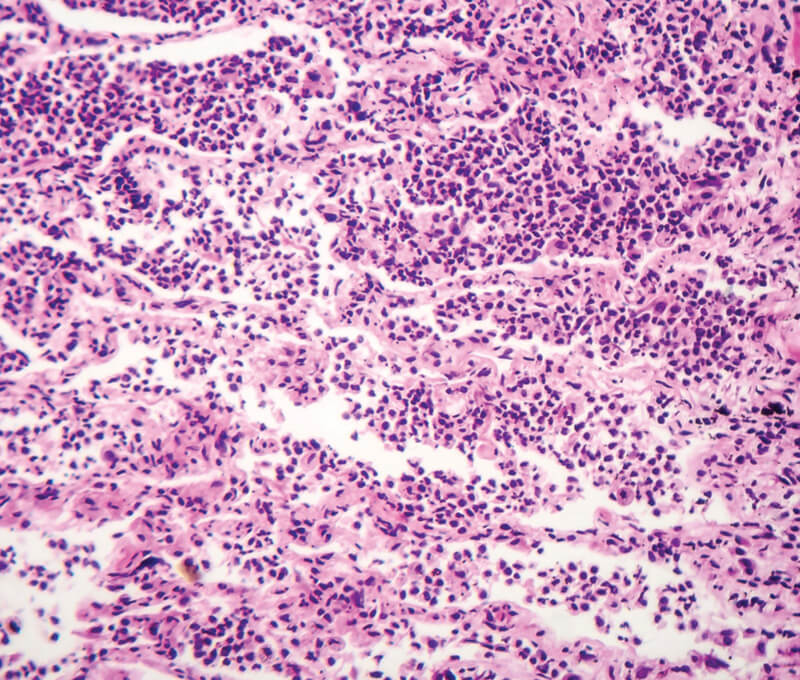 Fibrotic Idiopathic Interstitial Pneumonia