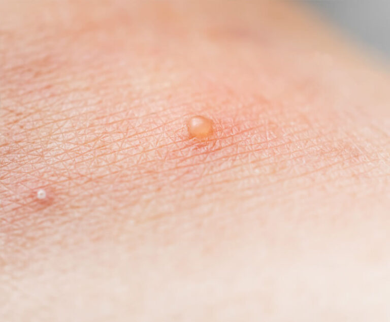 Update on Molluscum Contagiosum