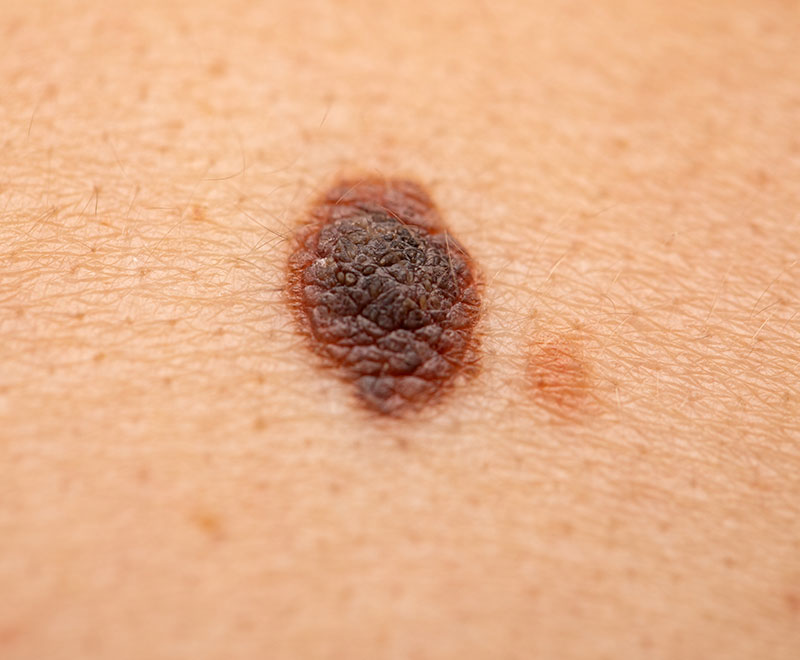 image of skin melanoma