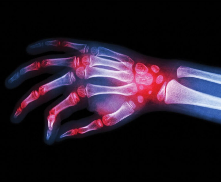 Illustration of inflammation in joints