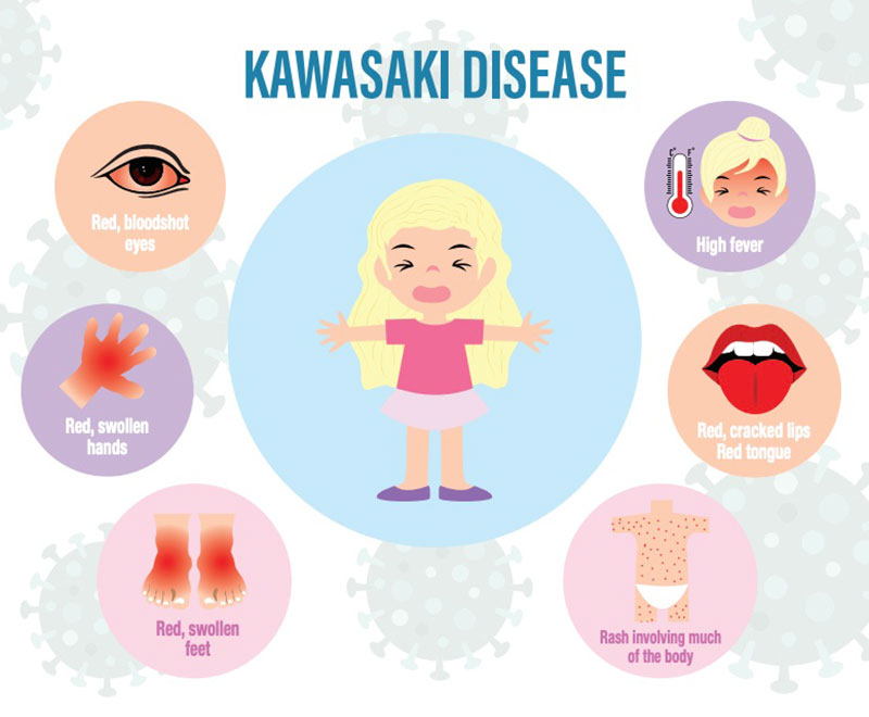 Kawasaki disease symptoms