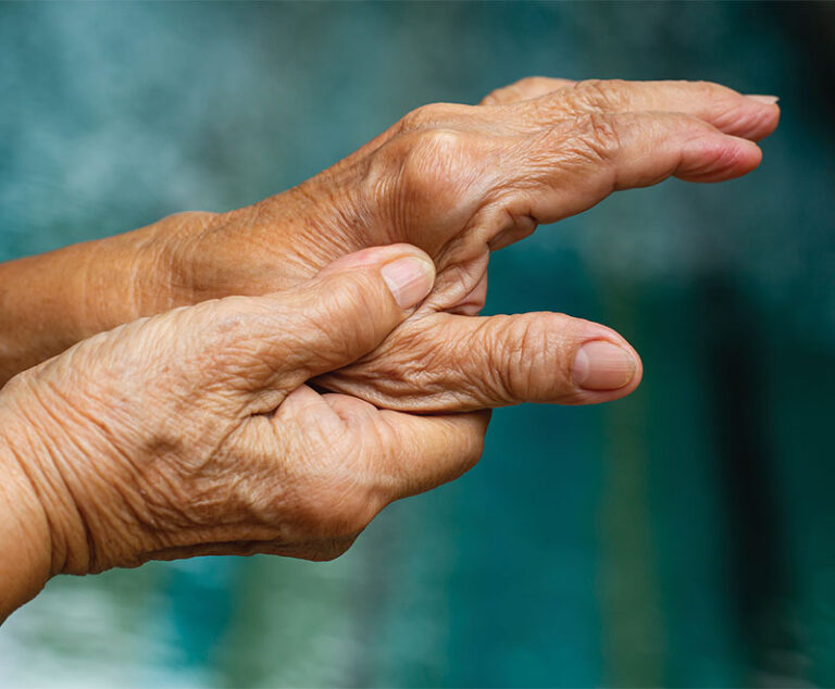 Photo of hands of patients with rheumatoid arthritis.